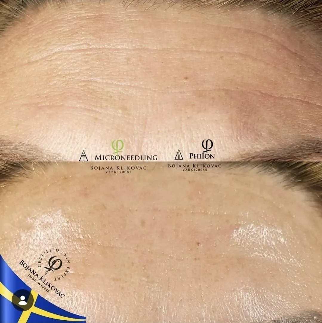 Före och efter microneedling – utslätade pannrynkor